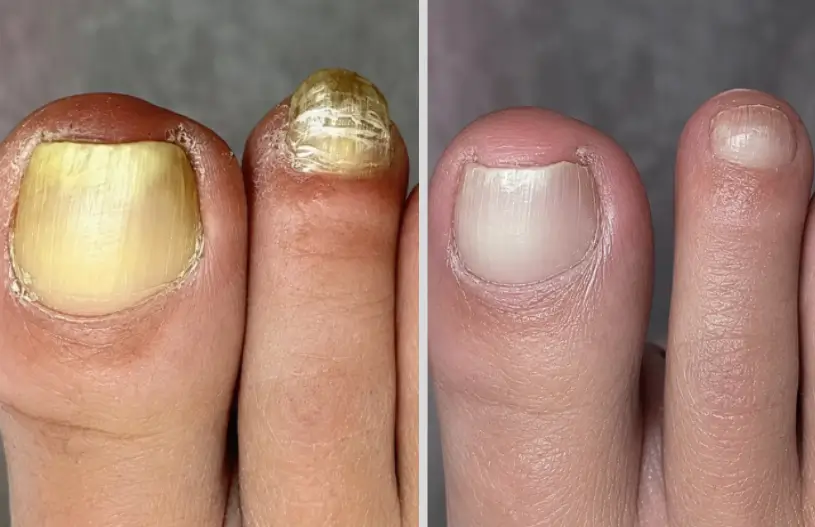 Mary T. — toenail fungus testimonial