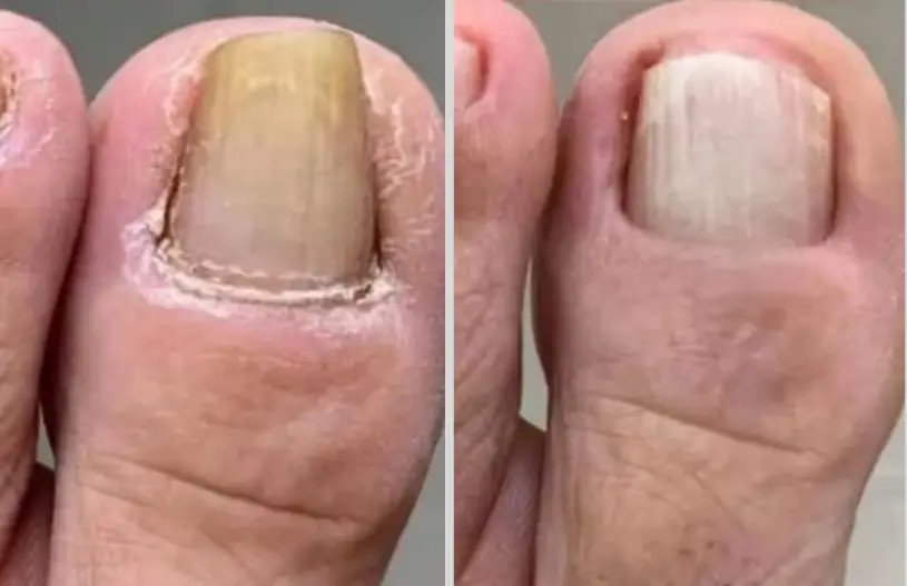 Linda R. — toenail fungus testimonial