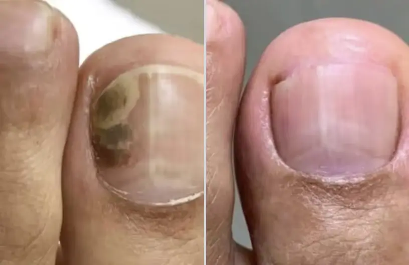 Robert M. — toenail fungus testimonial
